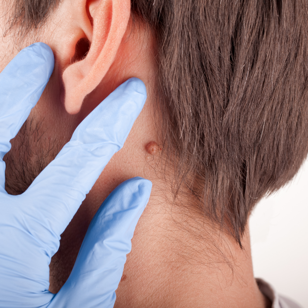 Atypical Mole Awareness Mole Removal Los Angeles