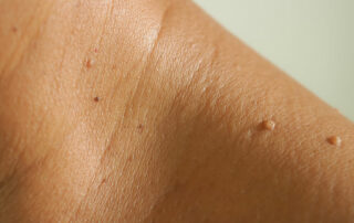 what is a skin tag orange county