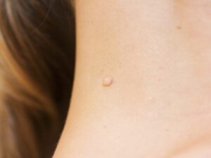 what is skin tag removal