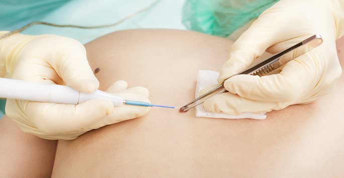 mole removal long beach