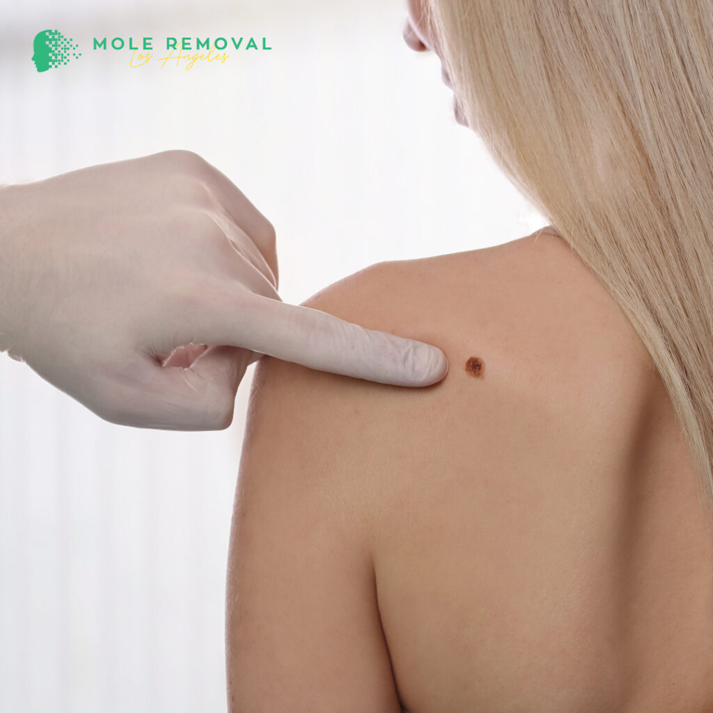 affordable mole removal burbank ca