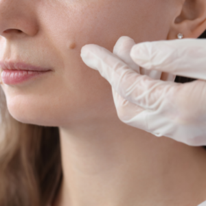 scarless mole removal Beverly Hills