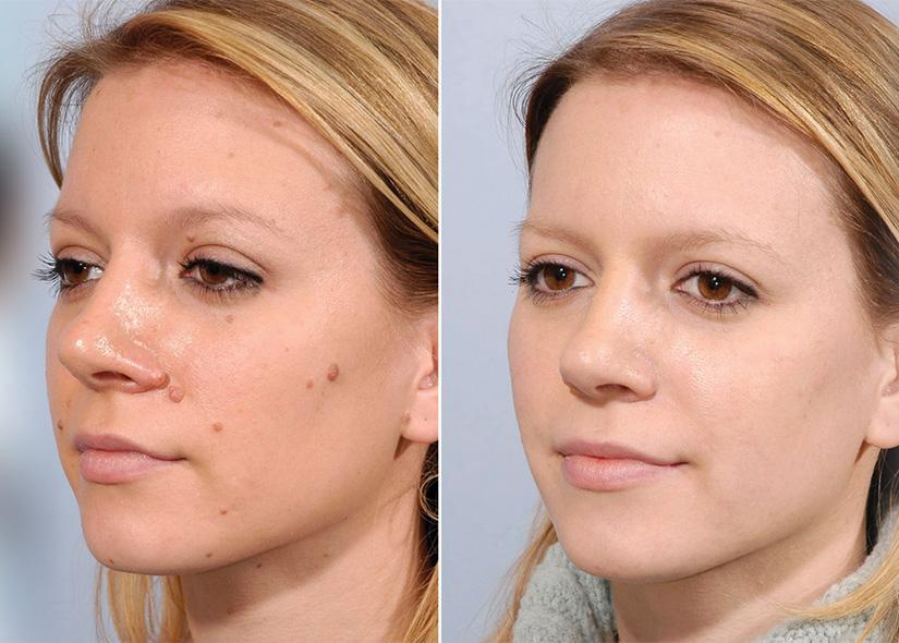 affordable mole removal los angeles before and after