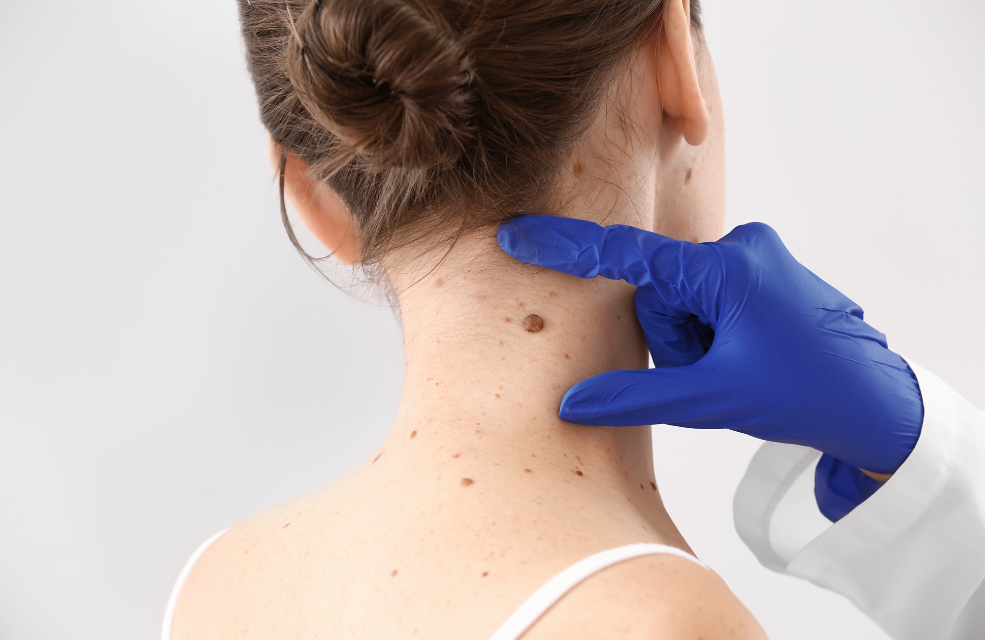 expert mole removal norwalk california