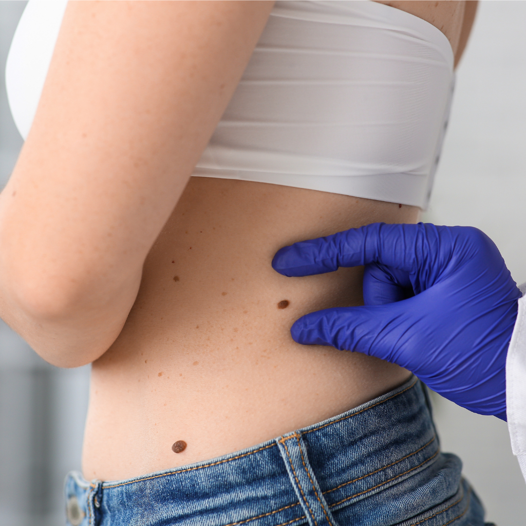 affordable mole removal Redondo beach