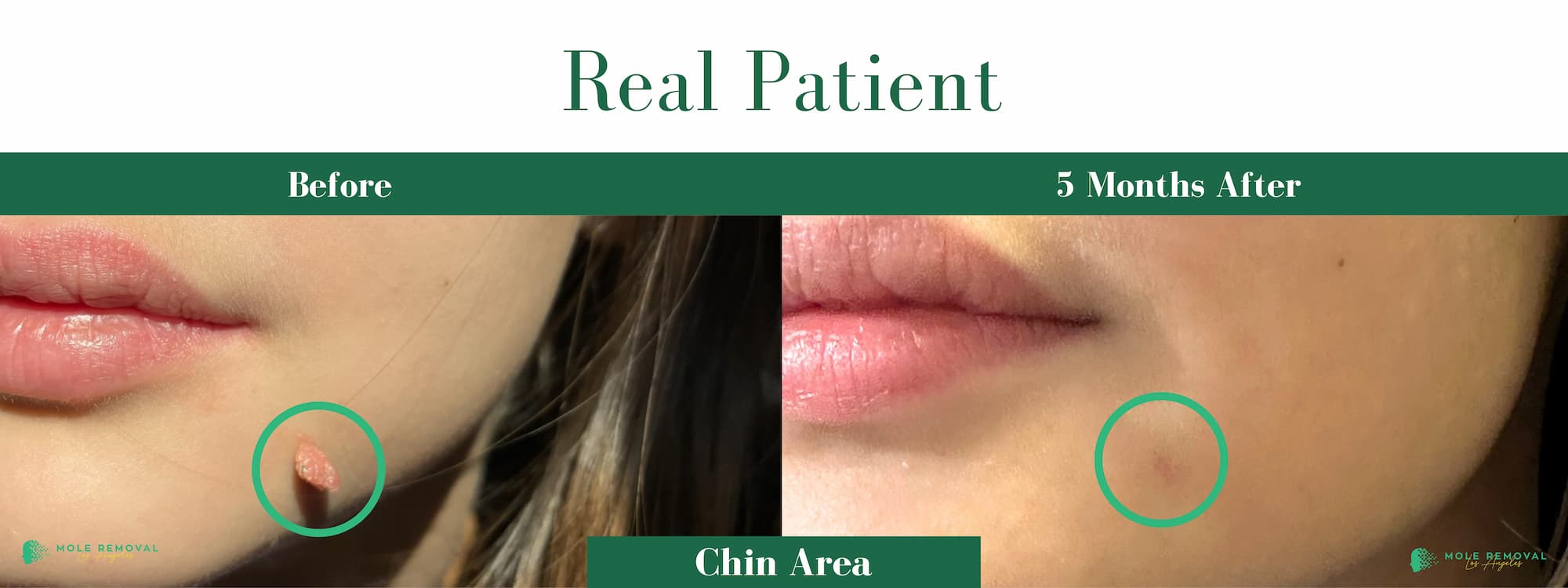 LA New before_after #12