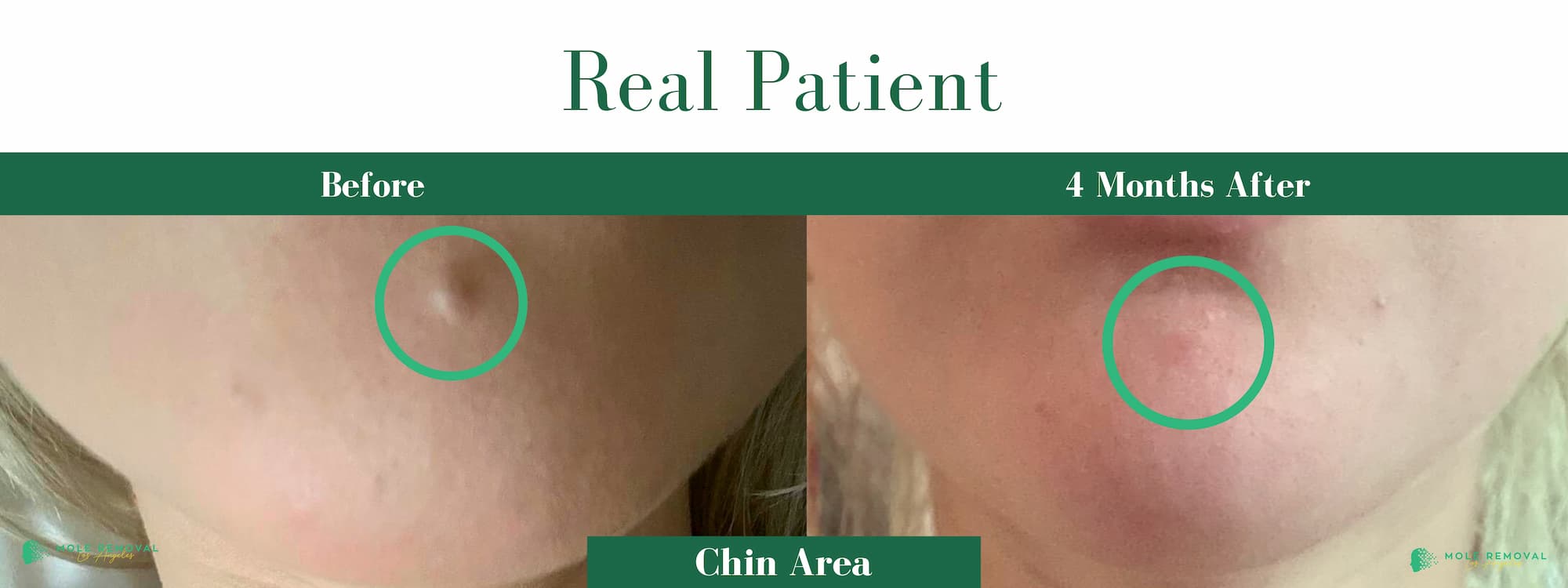 LA New before_after #13