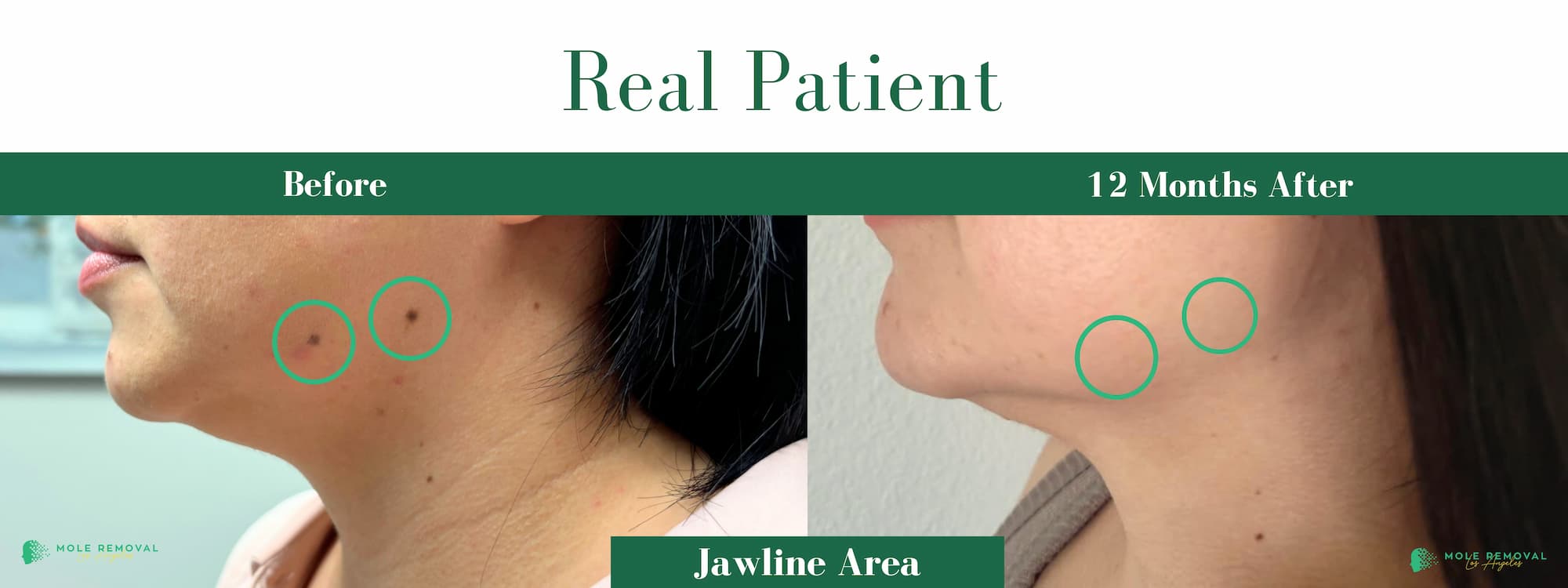 LA New before_after #14 (1) (1) (1)