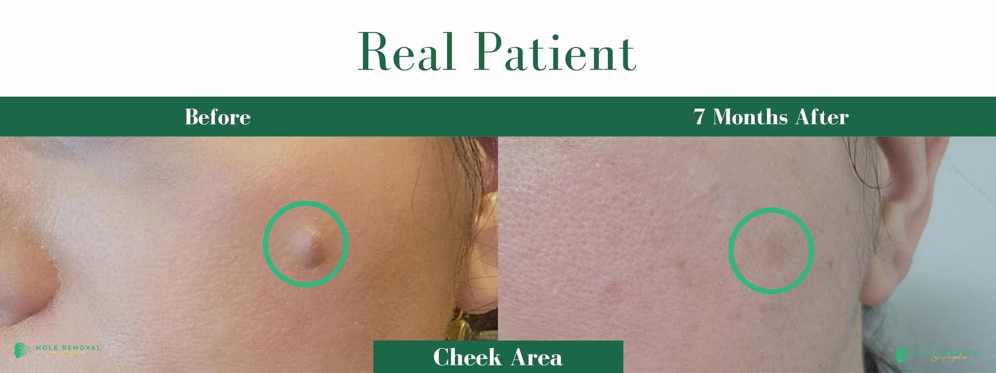 LA New before_after #15