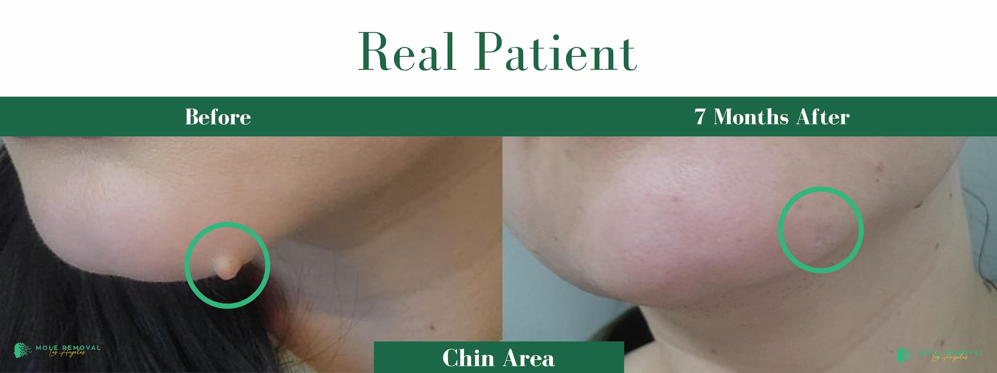 LA New before_after #16