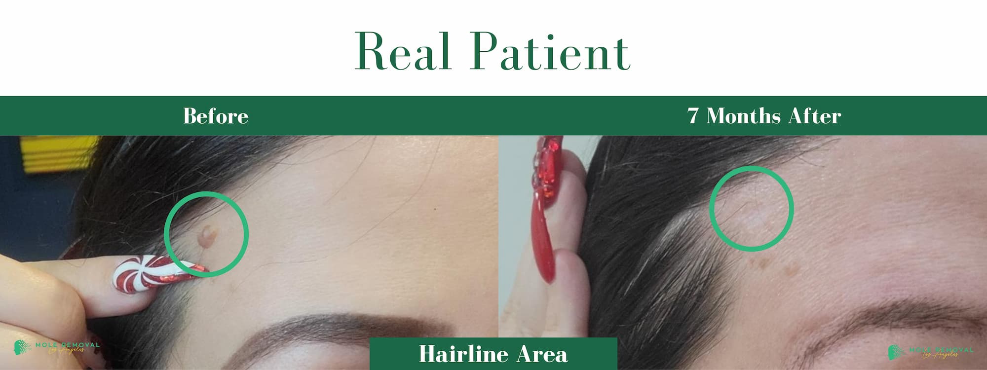 LA New before_after #17