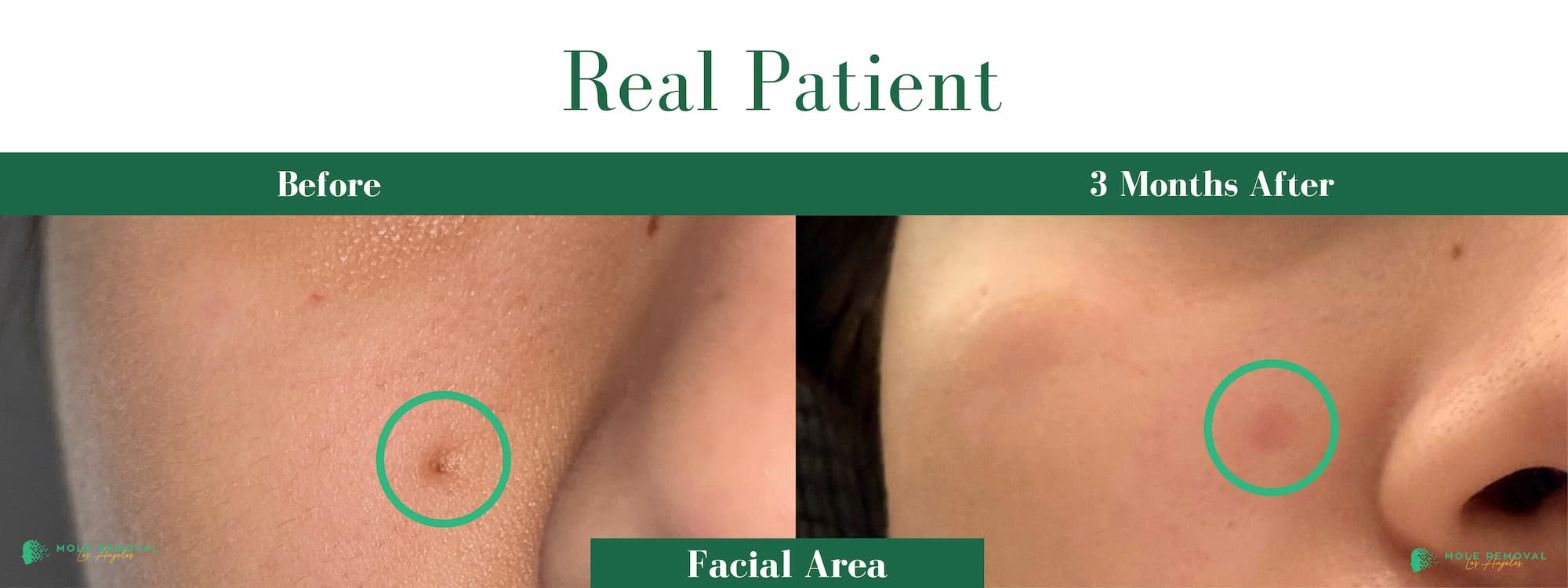 LA New before_after #18