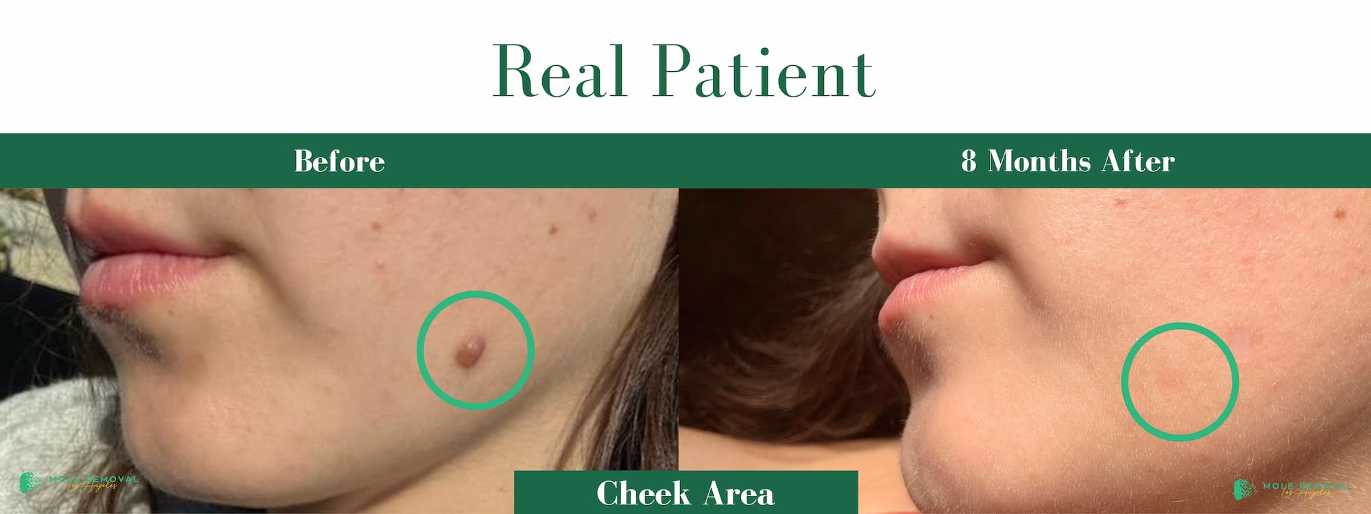 LA New before_after #19