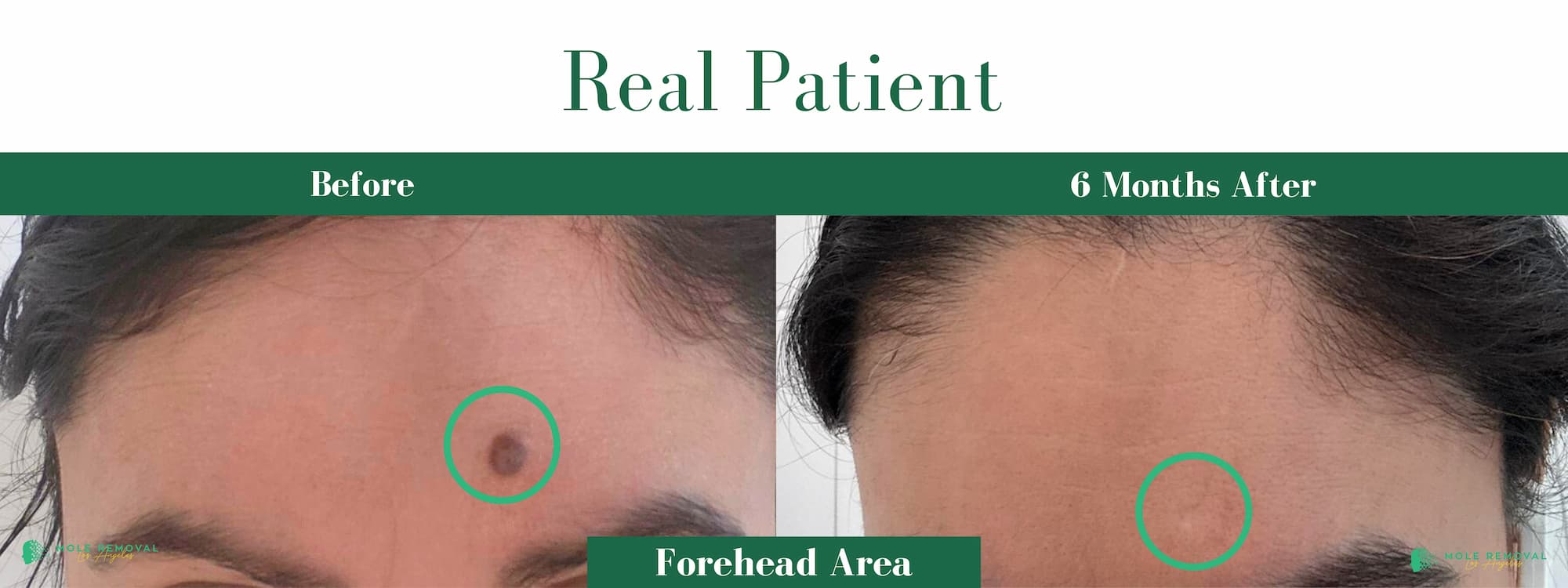 LA New before_after #20