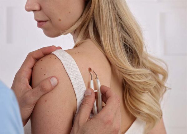 expert mole removal downey california