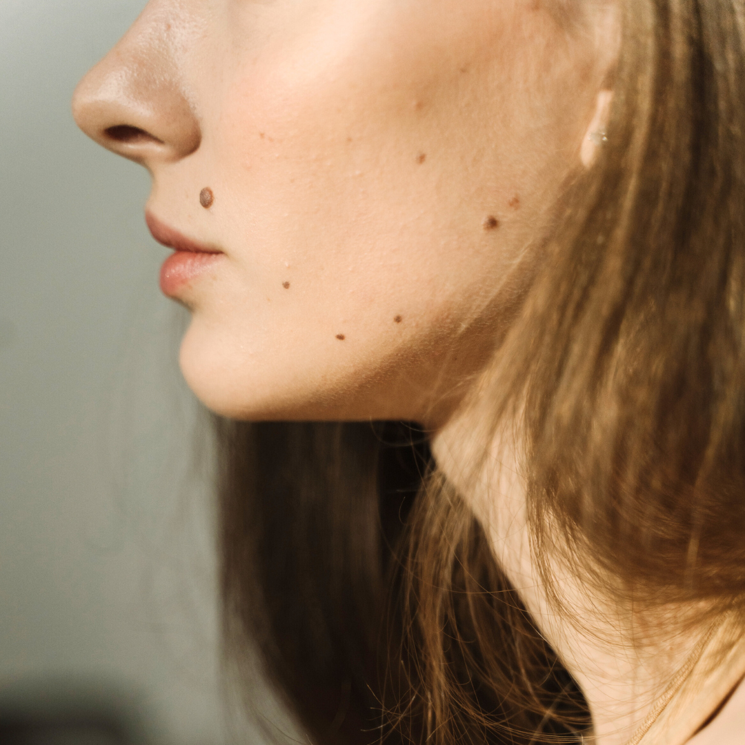 Wondering how much mole removal costs in Los Angeles