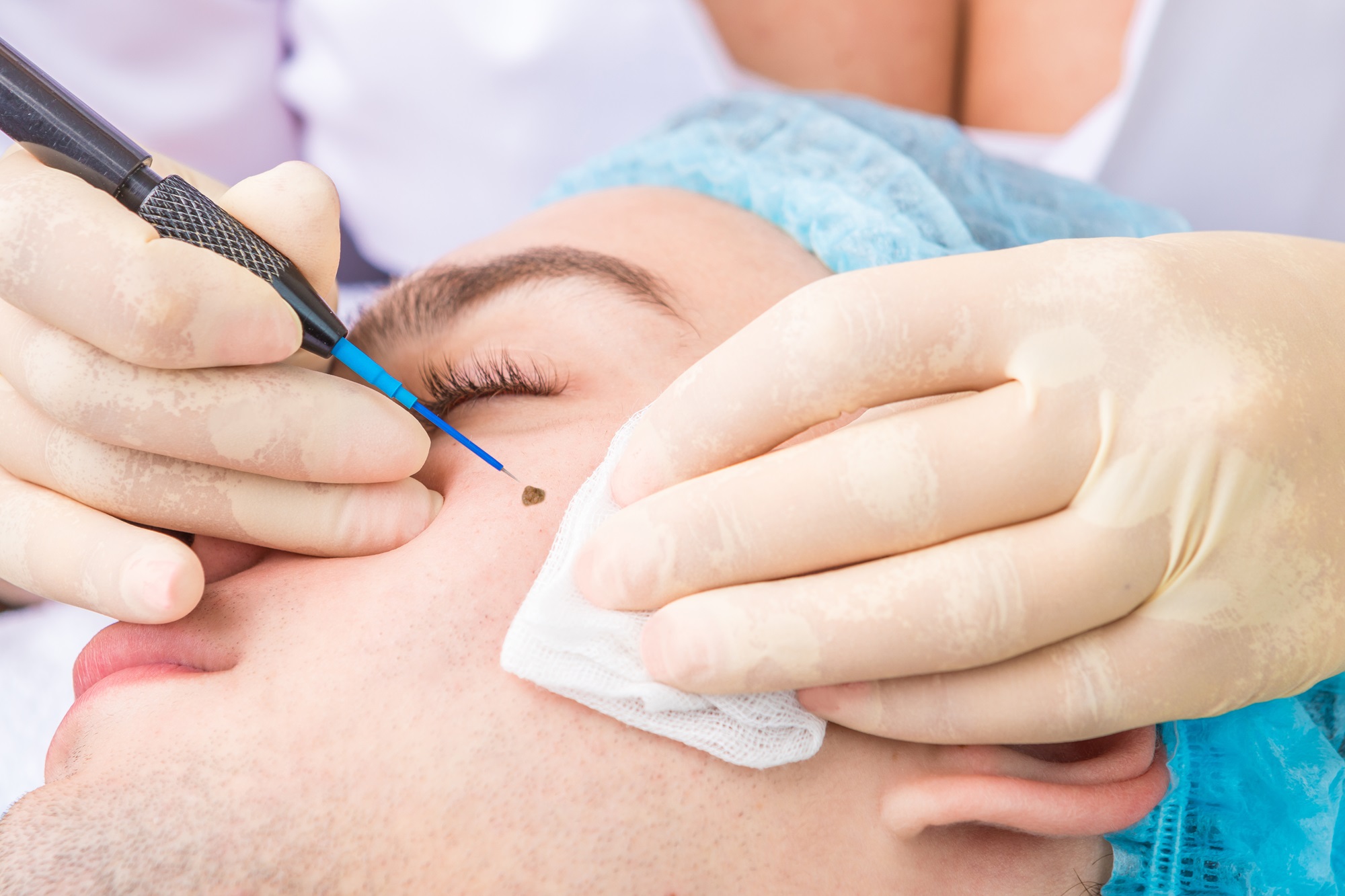 scarless mole removal Manhattan Beach