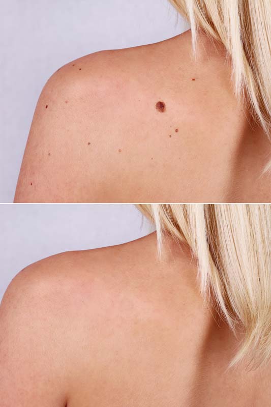 expert mole removal el segundo california