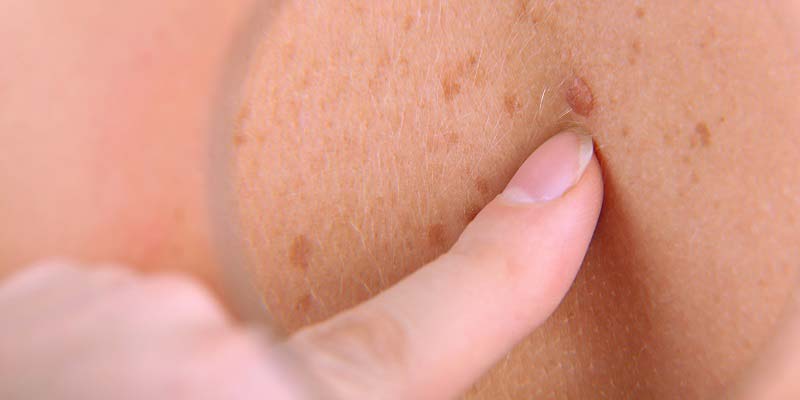 affordable eyelid skin tag removal