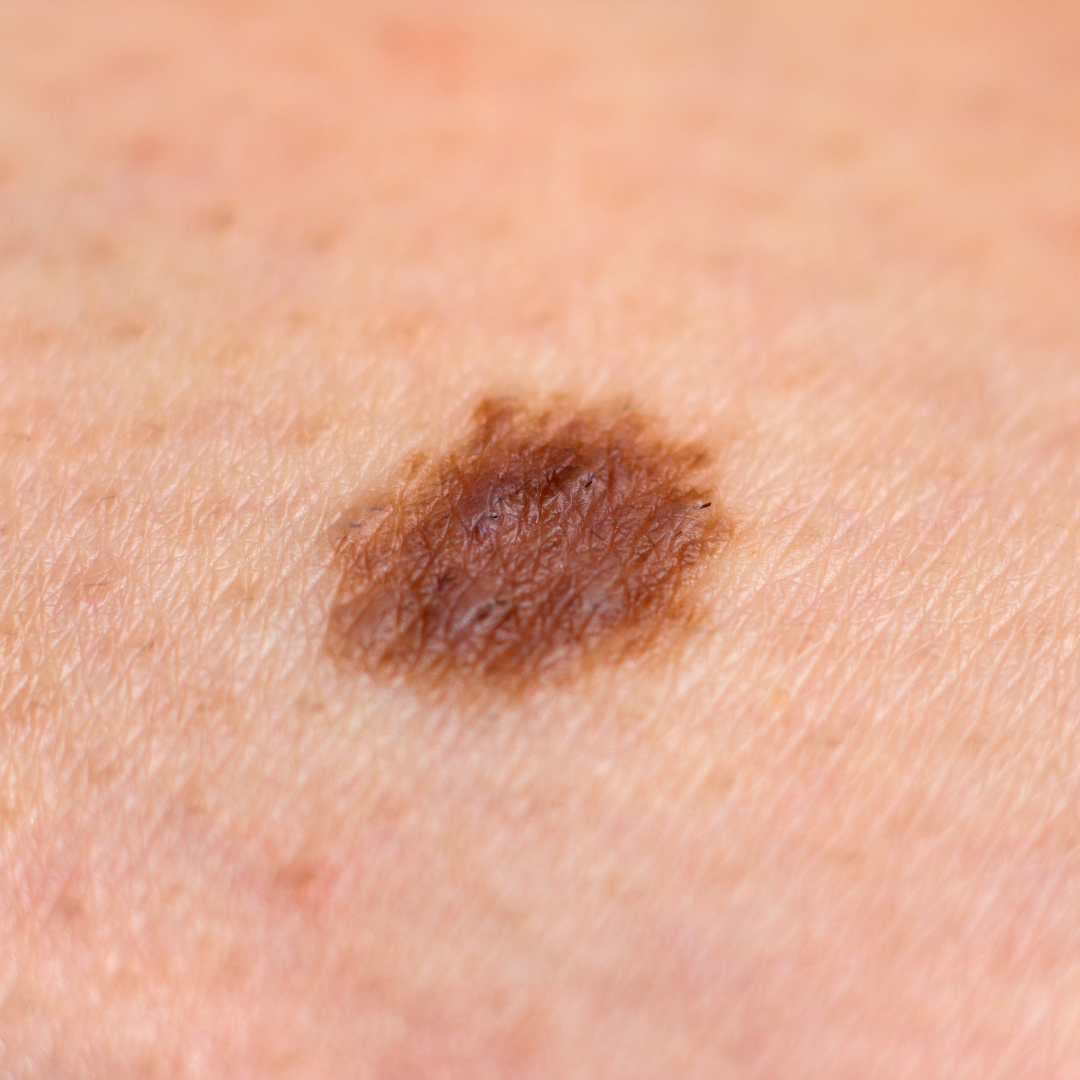 scarless mole removal culver city california