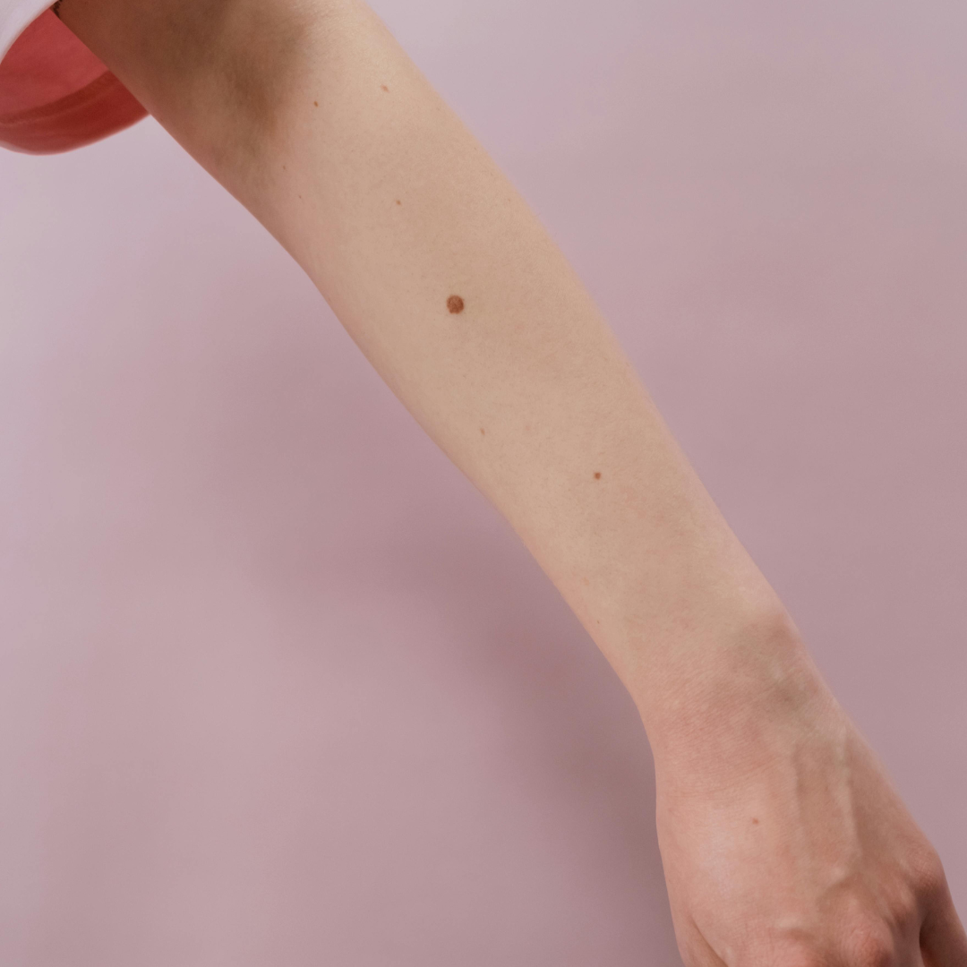 expert mole removal Rancho Palos Verdes