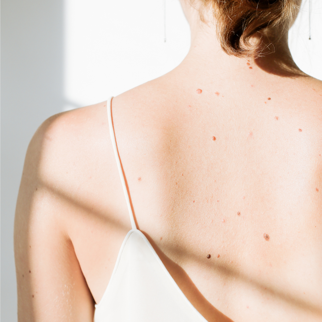 professional mole removal Huntington Park