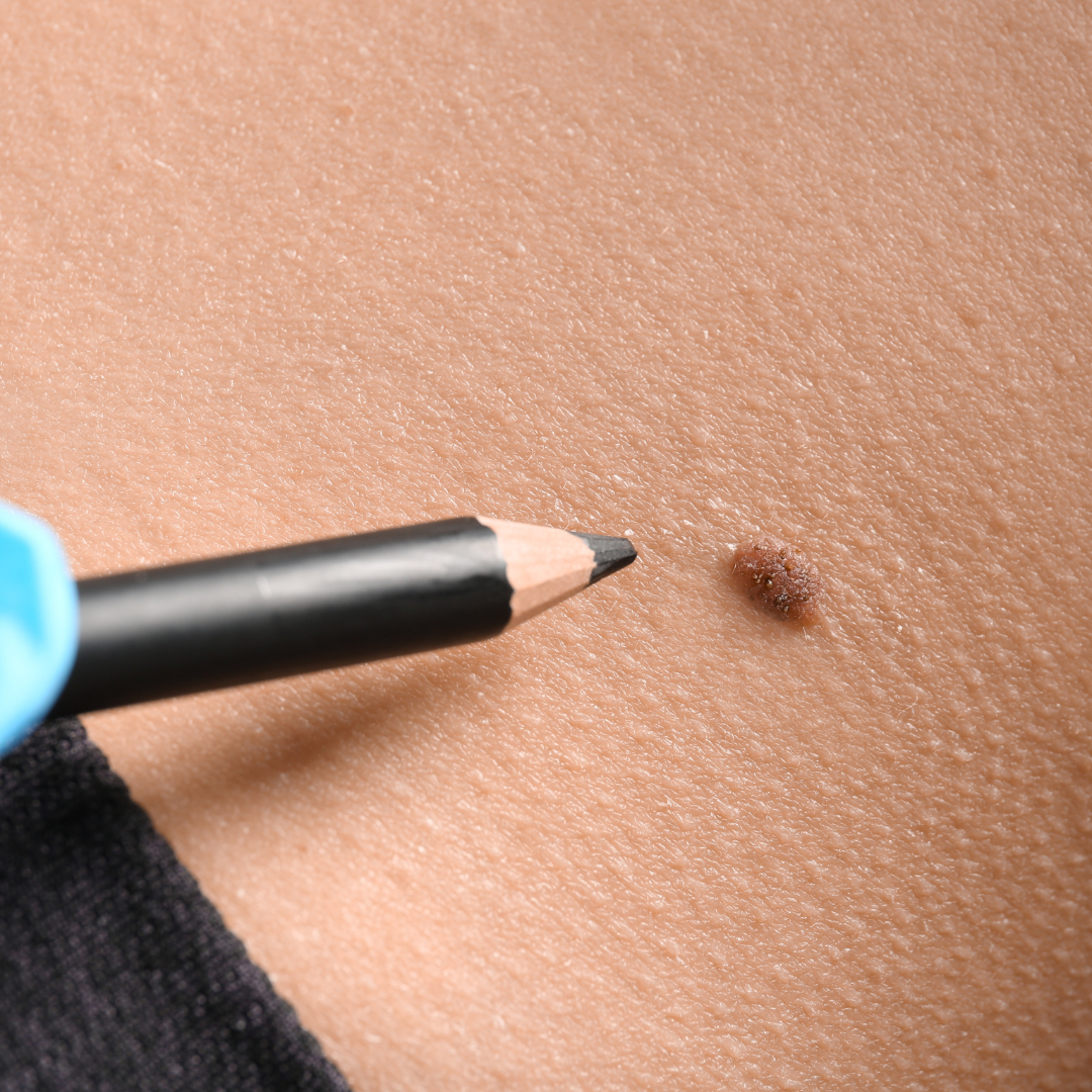 avoid at home mole removal