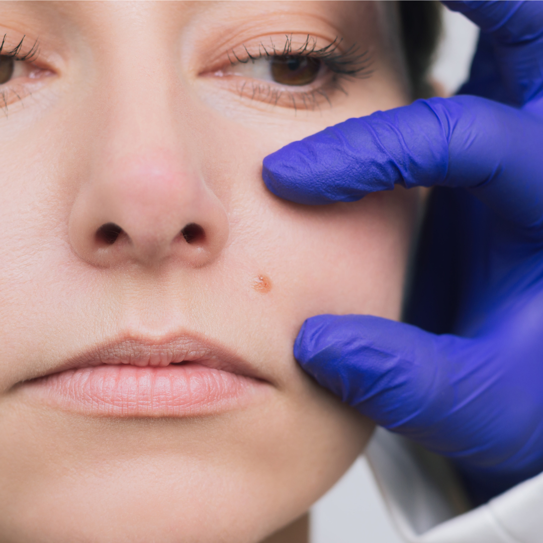 Does Mole Removal Leave a Scar